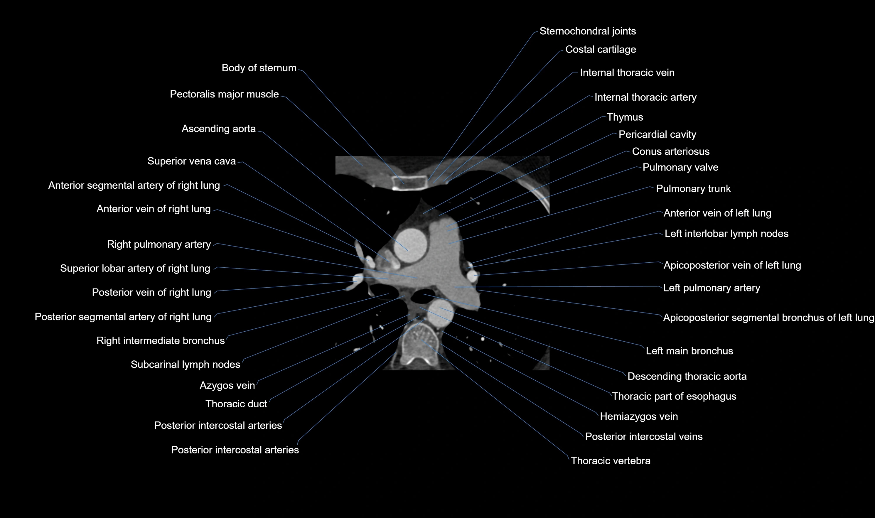 CT heart (coronary angiogram) axial view cross sectional anatomy labelled radiology image-00010.webp